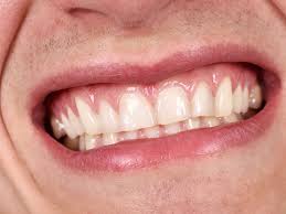 8 Variables Influencing Your Teeth Brightening Results
