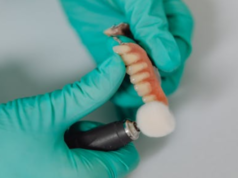 Your Guide to Dental Implant Recovery Dental Implant